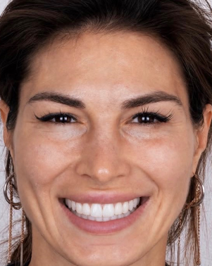 Illustrative smile visualization